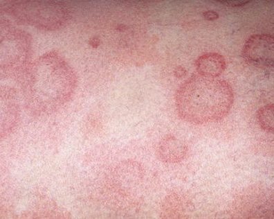 Почему чешется голова и как избавиться от зуда