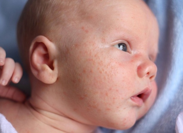 Как распознать диатез и что с ним делать