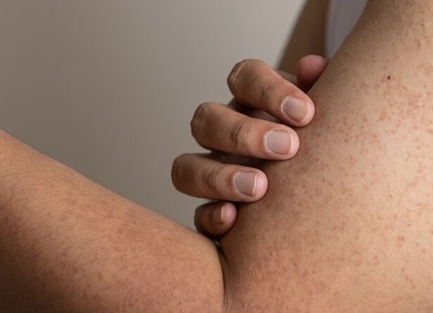 Откуда берётся гусиная кожа и почему не проходит