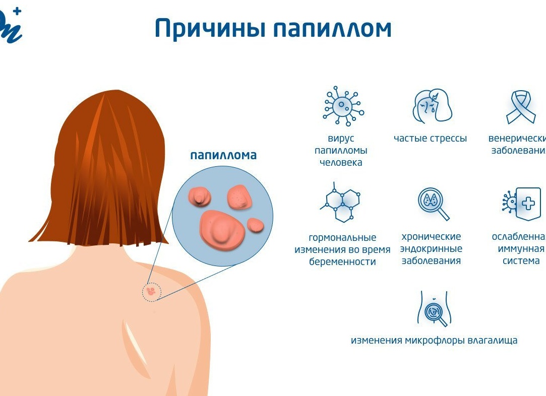 Чем опасен вирус папилломы человека и как от него избавиться