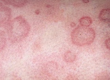 Почему чешется голова и как избавиться от зуда