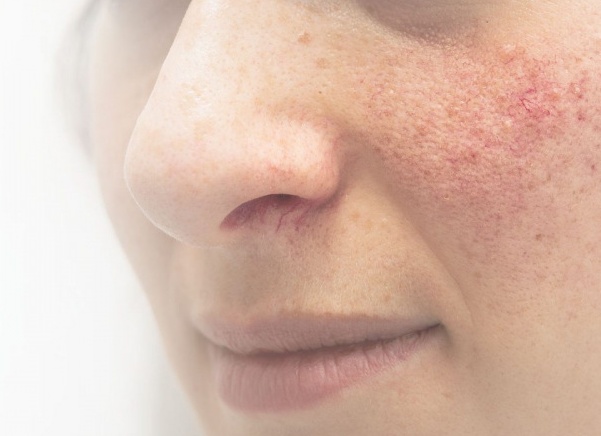 Что такое купероз на лице и можно ли его вылечить
