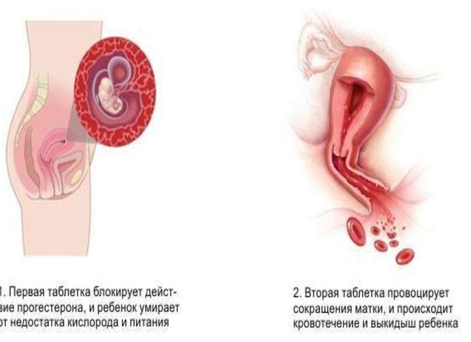 Как делают медикаментозный аборт и чем это опасно