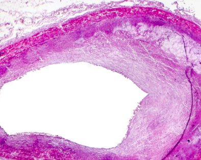 Как можно почистить сосуды на самом деле