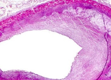 Как можно почистить сосуды на самом деле