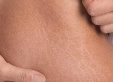 Как избавиться от растяжек