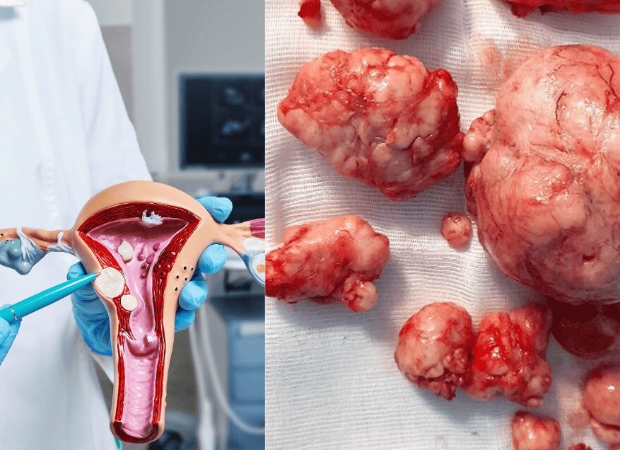 Миома матки: что это такое и как лечат  Здоровье