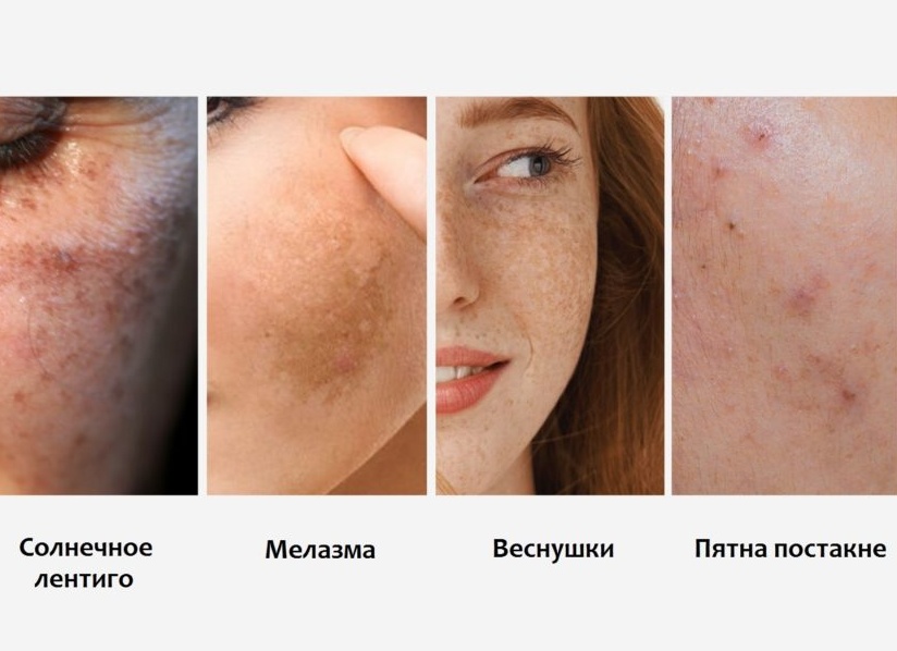 Почему появляются пигментные пятна и как от них избавиться