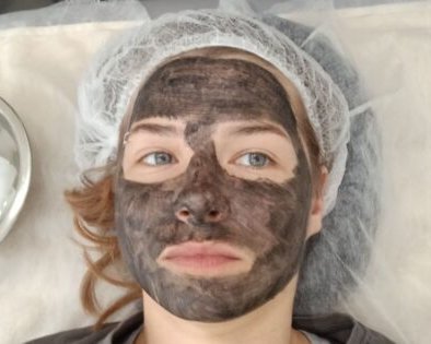 Правда ли карбоновый пилинг сделает кожу здоровой и сияющей