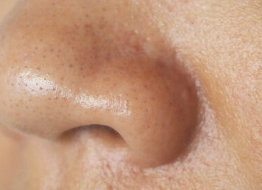 Пора признаться: чистка лица не спасёт от забитых и расширенных пор