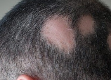 Алопеция: почему вы теряете волосы и как это лечить