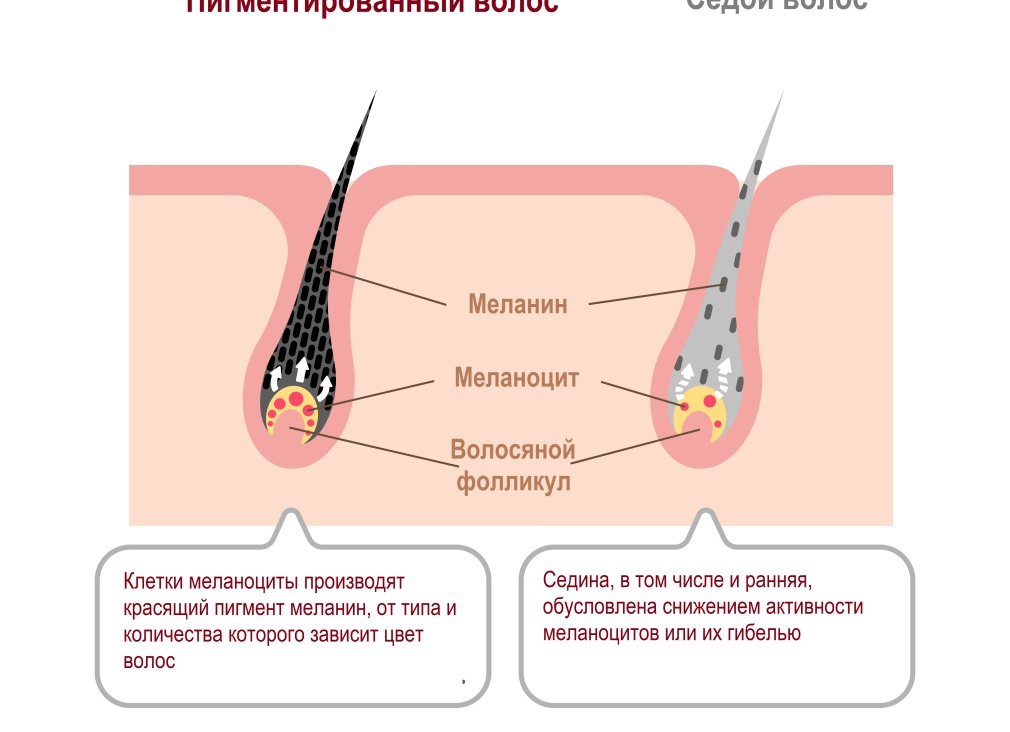 Почему появляются седые волосы и как от них избавиться