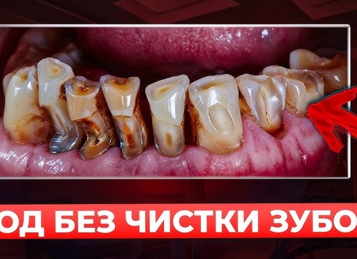 Что будет, если не чистить зубы