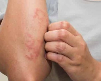 Как правильно сдавать анализы на аллергены