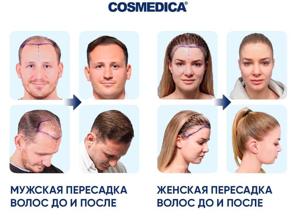 Выпадение волос: что является нормой и когда стоит начать беспокоиться