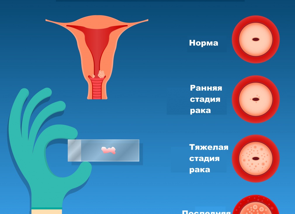 Откуда берётся рак шейки матки и как его лечить