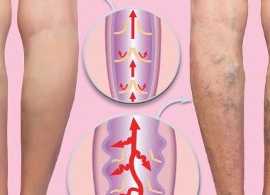 Что делать сейчас, чтобы потом не страдать от варикоза