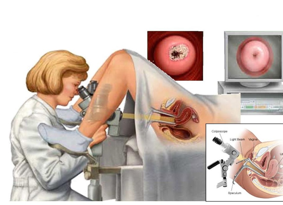 Что такое кольпоскопия и как к ней подготовиться