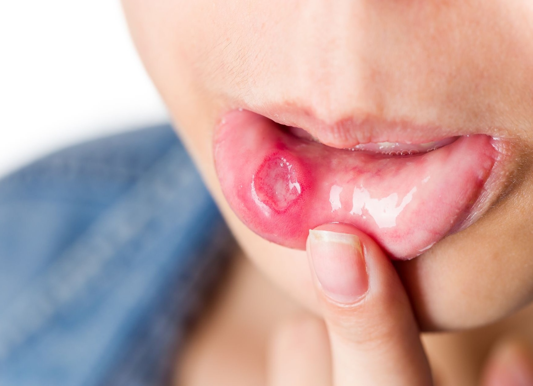 Почему во рту появляются язвы и что с ними делать