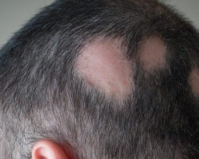 Алопеция: почему вы теряете волосы и как это лечить