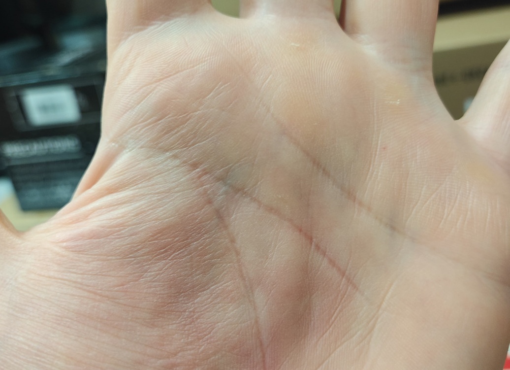 Почему чешутся ладони и что с этим делать