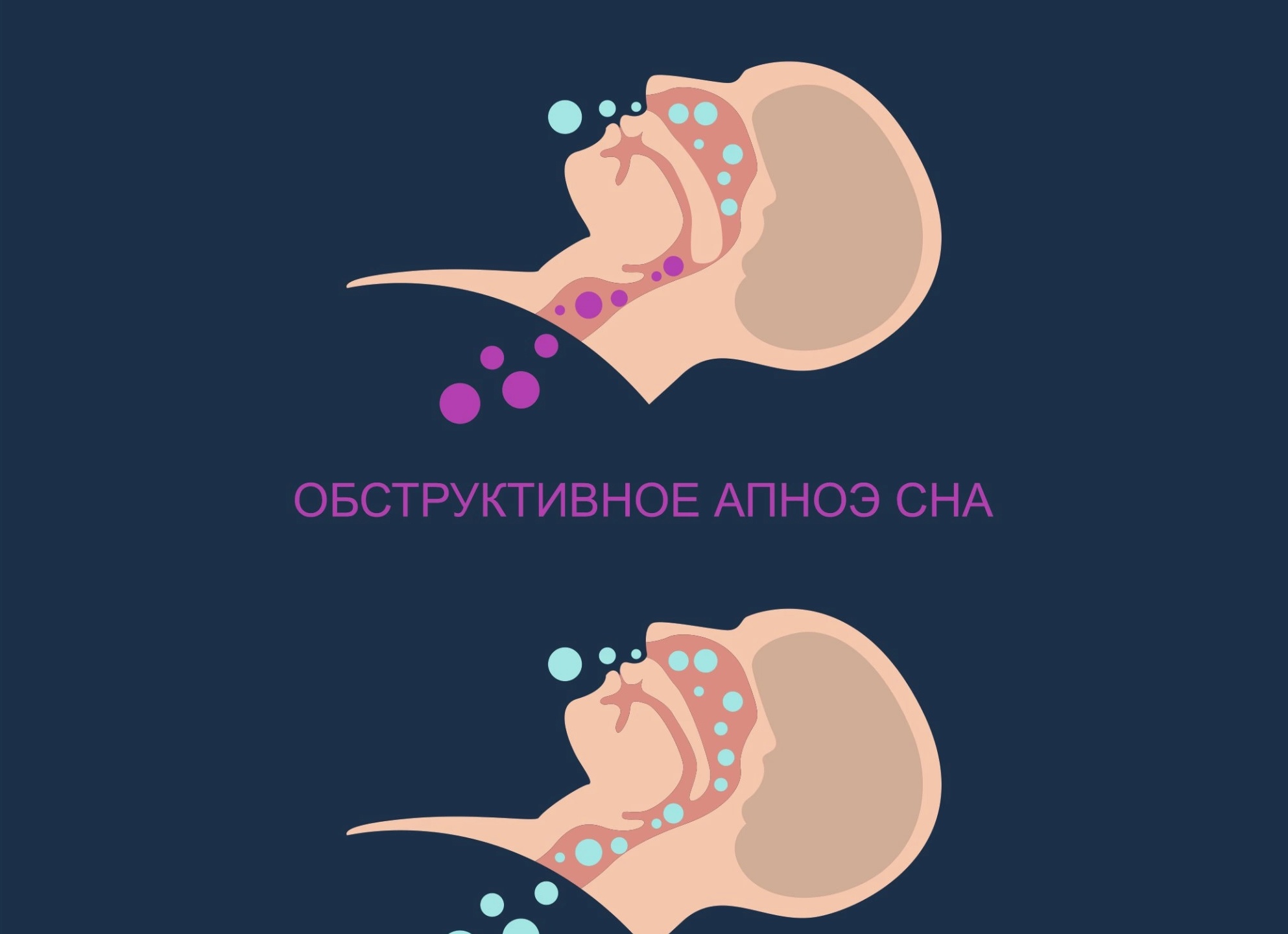 Как избавиться от храпа быстро и навсегда
