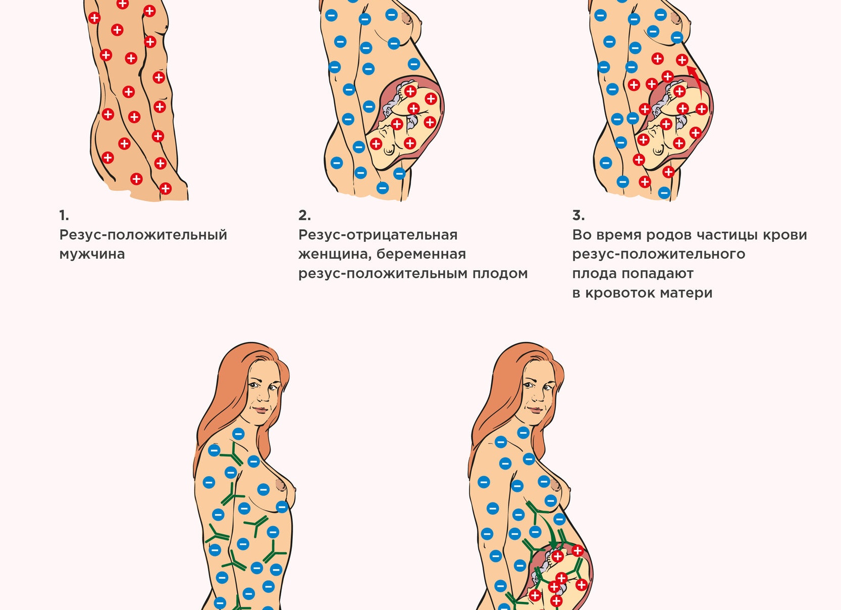 Чем опасен резус-конфликт при беременности и что с этим делать