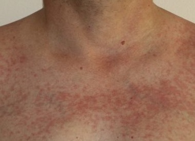 Что такое аллергия на солнце и что с ней делать