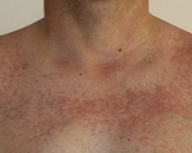 Что такое аллергия на солнце и что с ней делать