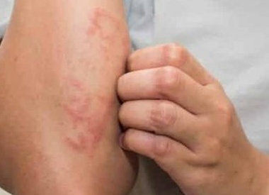 Как правильно сдавать анализы на аллергены