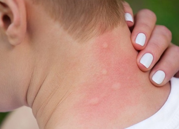 Что делать, если у вас аллергия на укусы комаров и мошек