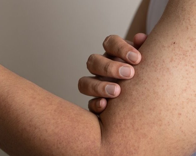 Откуда берётся гусиная кожа и почему не проходит